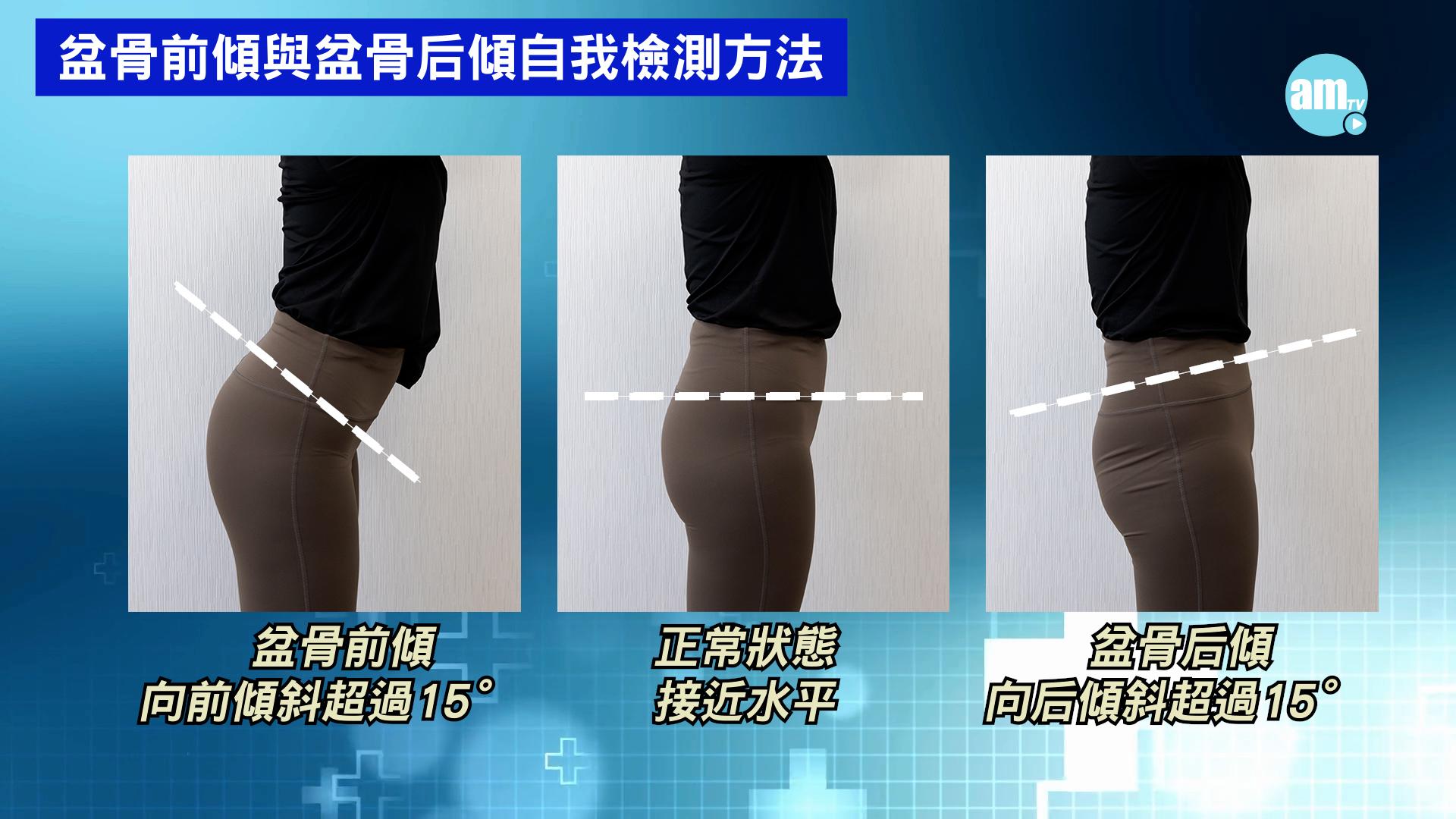 若前後斜度超過15°,則可能存在盆骨前傾或後傾的情況。
