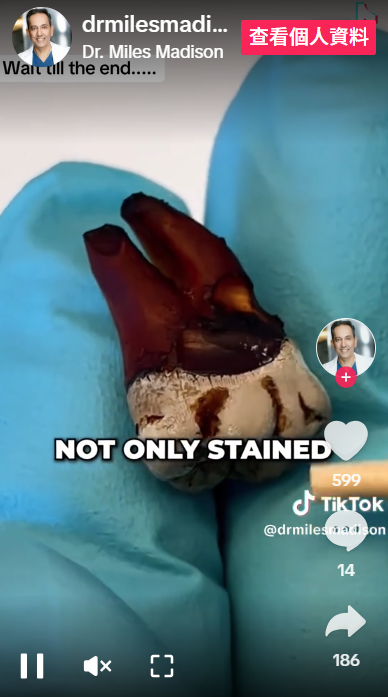 可樂把牙齒染深色之餘,亦有腐蝕情況。(互聯網)