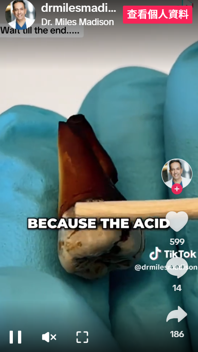 可樂把牙齒染深色之餘,亦有腐蝕情況。(互聯網)