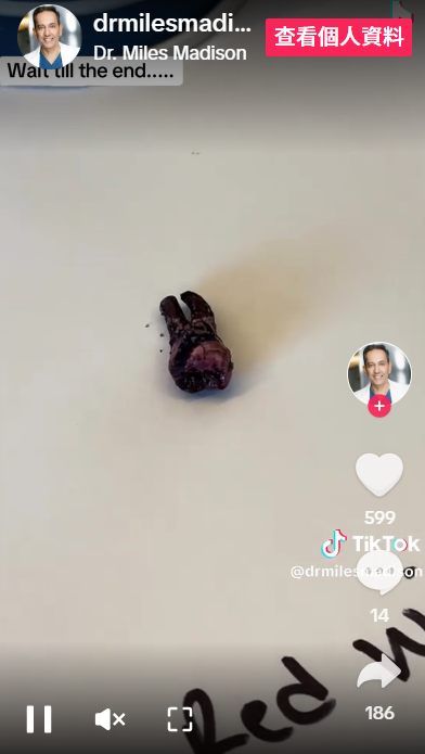 紅酒把整顆牙齒「上色」。(互聯網)