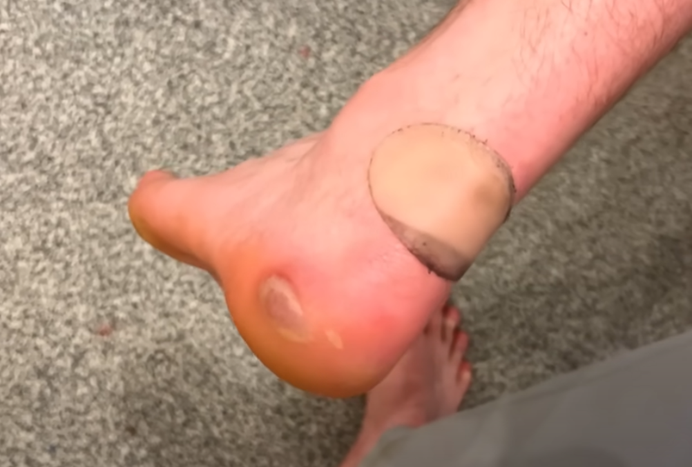 連續多天的挑戰讓威爾許的雙腳劇痛,甚至需要止痛藥來幫助行走,腳上出現了許多水泡