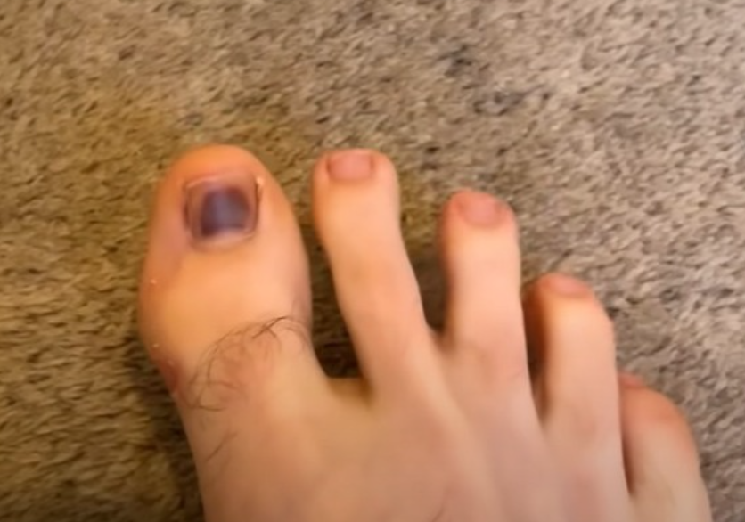 走到腳指甲發黑