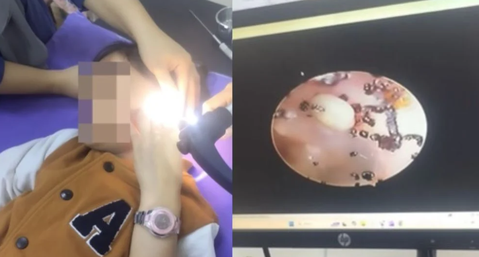 女童海法接受內窺鏡檢查,竟照出駭人異物。(互聯網)