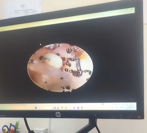 女童海法接受內窺鏡檢查,竟照出駭人異物。(互聯網)