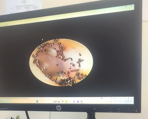 女童海法接受內窺鏡檢查,竟照出駭人異物。(互聯網)