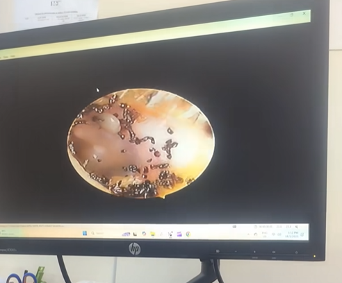 女童海法接受內窺鏡檢查,竟照出駭人異物。(互聯網)