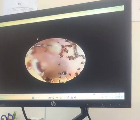 女童海法接受內窺鏡檢查,竟照出駭人異物。(互聯網)