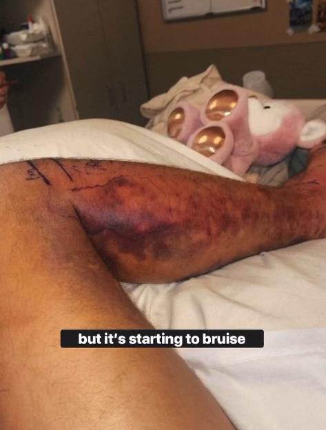 醫院為David注射了88瓶抗蛇毒血清後,他的小腿發紫腫脹,其後之後在加護病房中繼續接受治療。(IG)