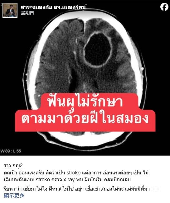 泰國神經學專家蘇拉特在Facebook發文,分享老婦因蛀牙導致腦膿瘍的個案。(互聯網)