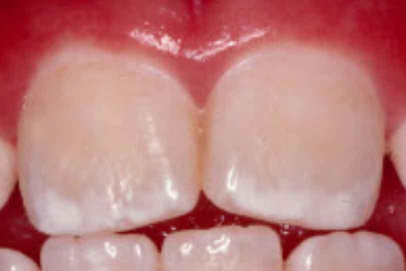 如飲用水中氟含量過高或使用過多含氟產品,可能導致牙齒白斑或黃褐色斑點,影響美觀甚至琺瑯質健康。