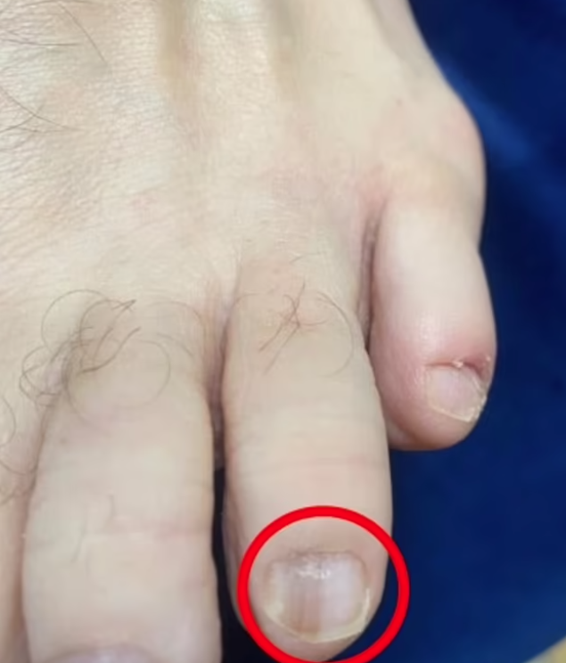 Edges的腳甲出現不明的線,而且愈變愈闊。(互聯網)