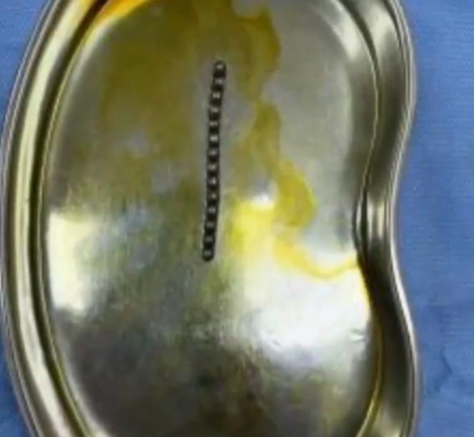 醫生最終通過微創手術,成功將磁力珠全部取出。(微博)