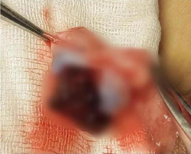 男童受損睪丸。(微博)