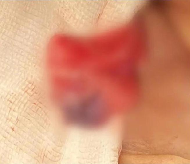 男童修復後睪丸。(微博)