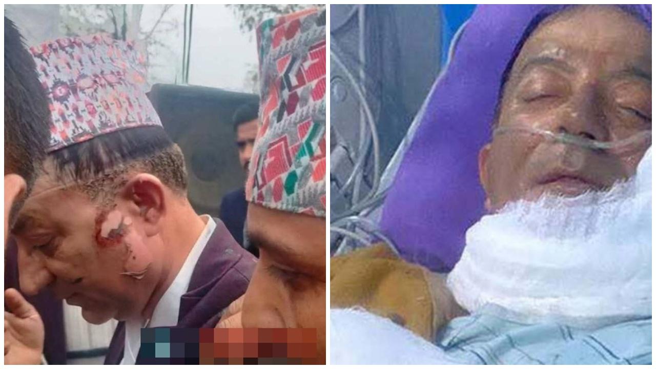 Acharya臉部被灼燒。(X)