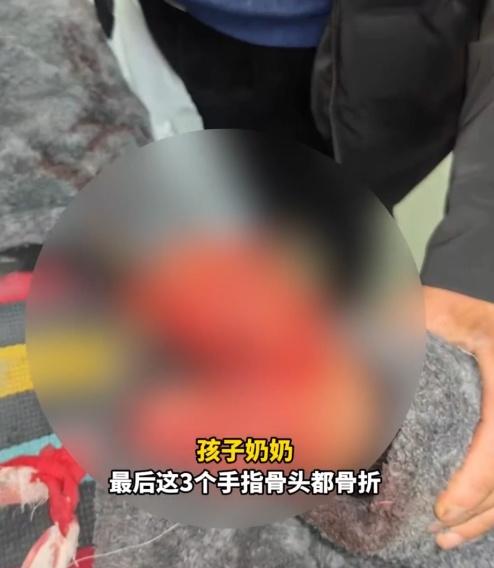 男童的婆婆表示,男童的右手大拇指和食指已經沒有了。(微博)
