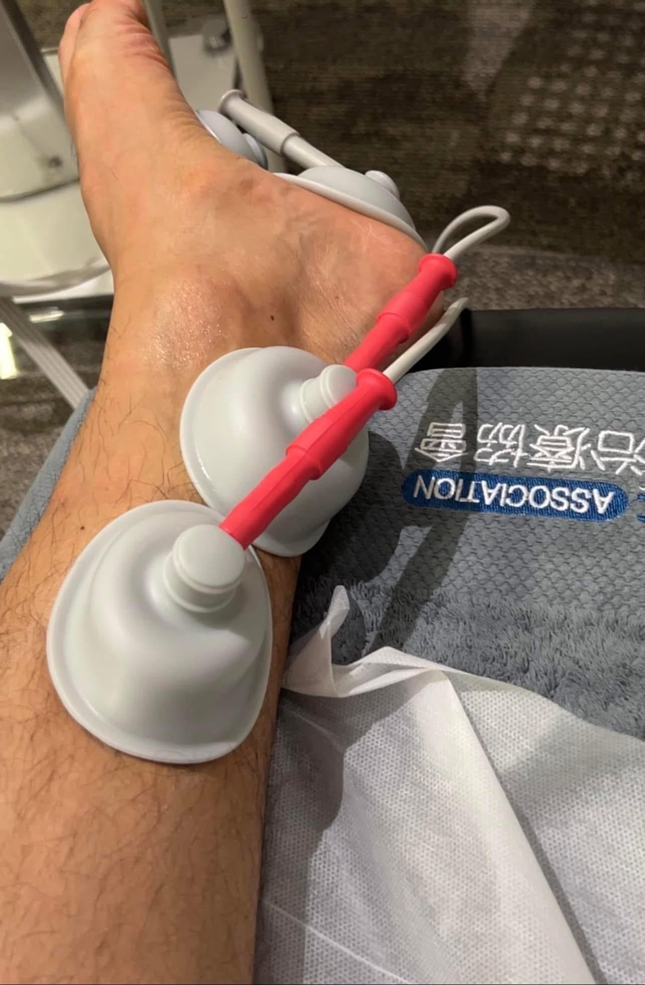 黃建東憂足底筋膜炎影響表現。