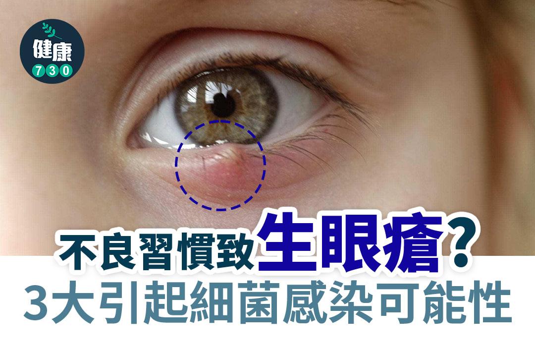 生眼挑針原因|不良習慣或引起細菌感染(am730製圖)