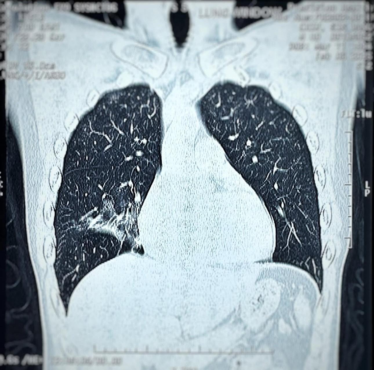 恆仔公開照肺部的X光片,發現右邊肺有肺花。