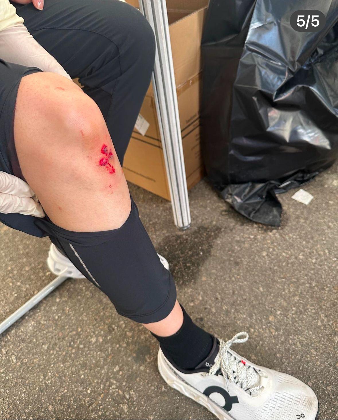 詩詠在比賽期間跌倒並擦傷了膝蓋。