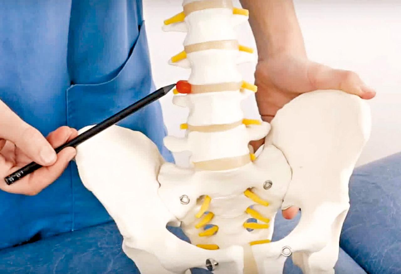 椎間盤突出的種類