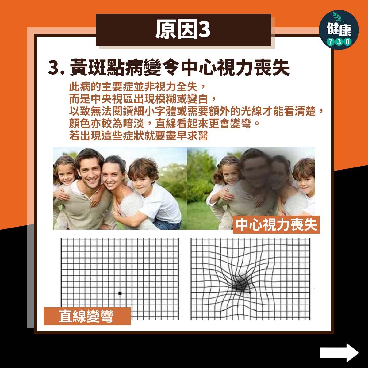 黃斑點病變原因|中心視力喪失(am730製圖)