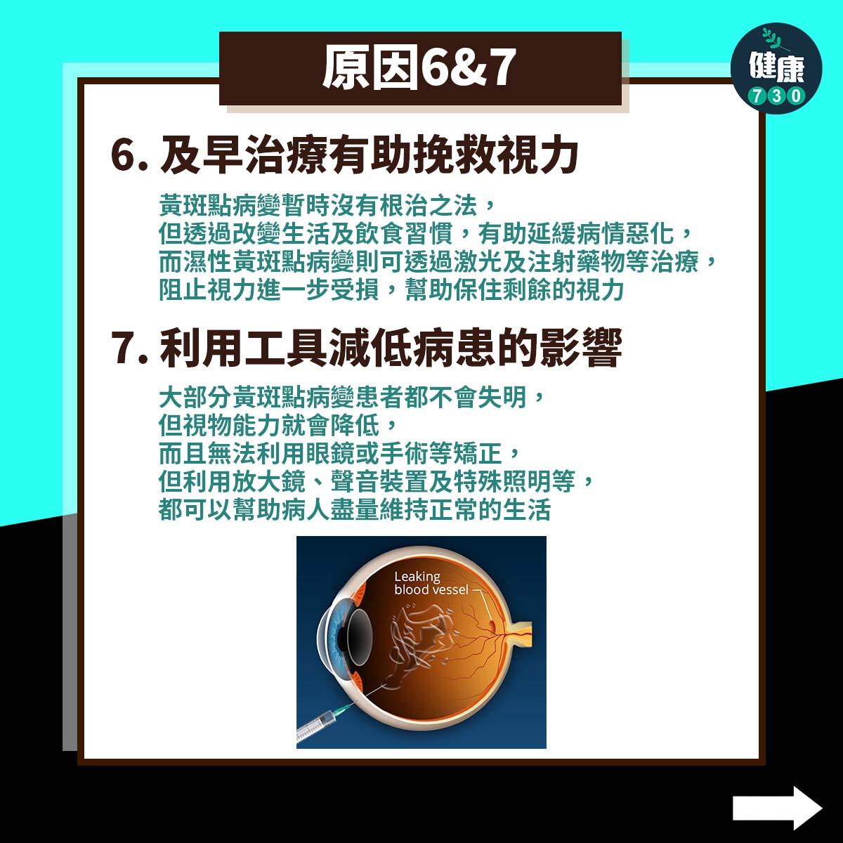 黃斑點病變原因|及早治療有助挽救視力(am730製圖)