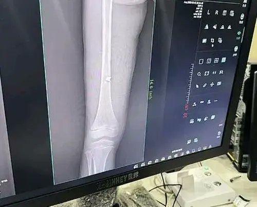 內地貴州省畢節市驚傳手榴彈爆炸事件,當地一名6歲女童撿到一個手榴彈,好奇拉下引線,竟當場引爆,女童腿骨瞬間被飛出的彈片擊中,受傷血流如注。