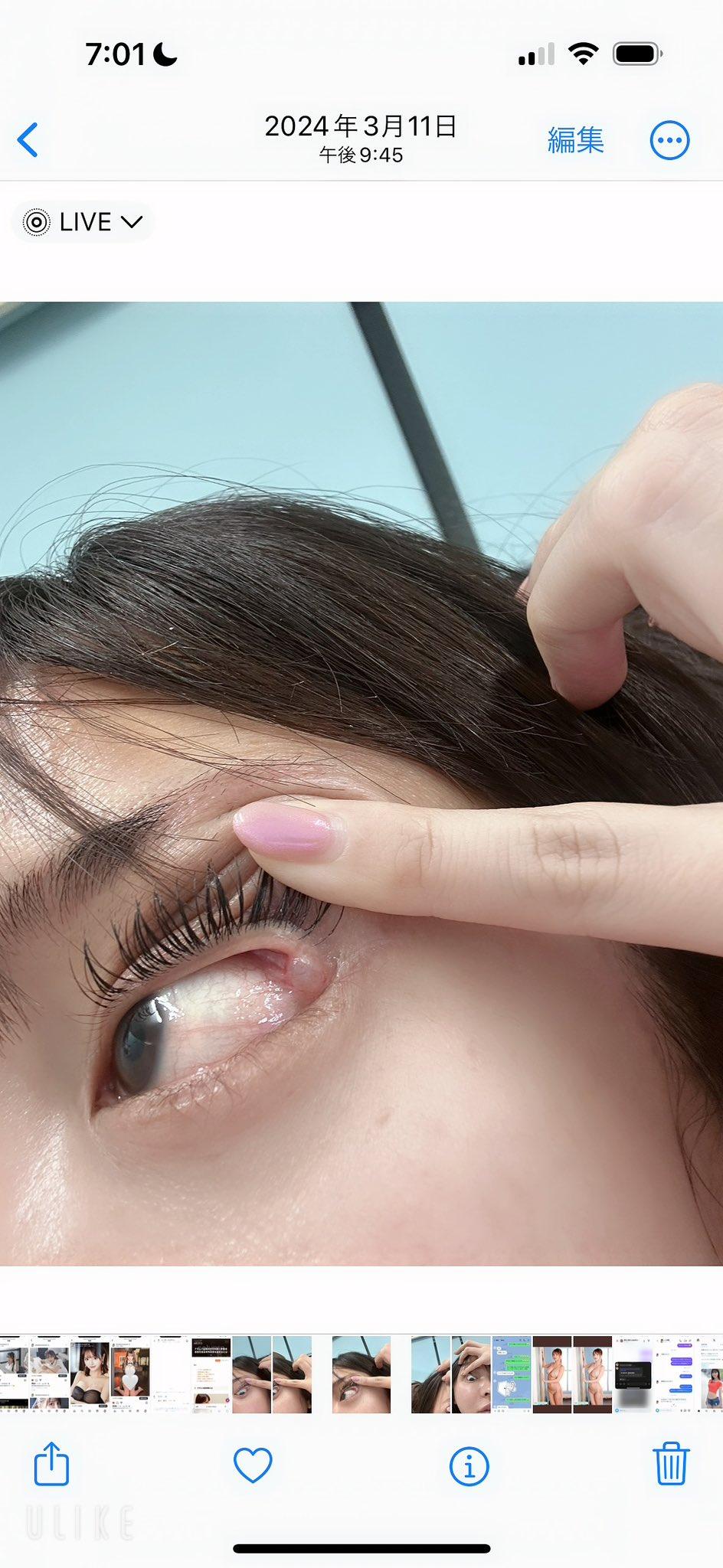 白浜希約1年前在東京銀座的著名整形醫院開刀「微調」,並加錢叫院長親自操刀,點知手術結果不似預期,本來加深雙眼皮變成「三眼皮」,嚴重影響工作。