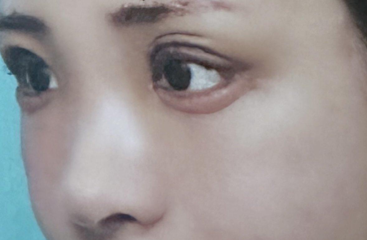 據AV達人一劍浣春秋在網上爆料,白浜希約1年前在東京銀座的著名整形醫院開刀「微調」,並加錢叫院長親自操刀,點知手術結果不似預期,本來加深雙眼皮變成「三眼皮」,嚴重影響工作。(@NozomiShirahama)