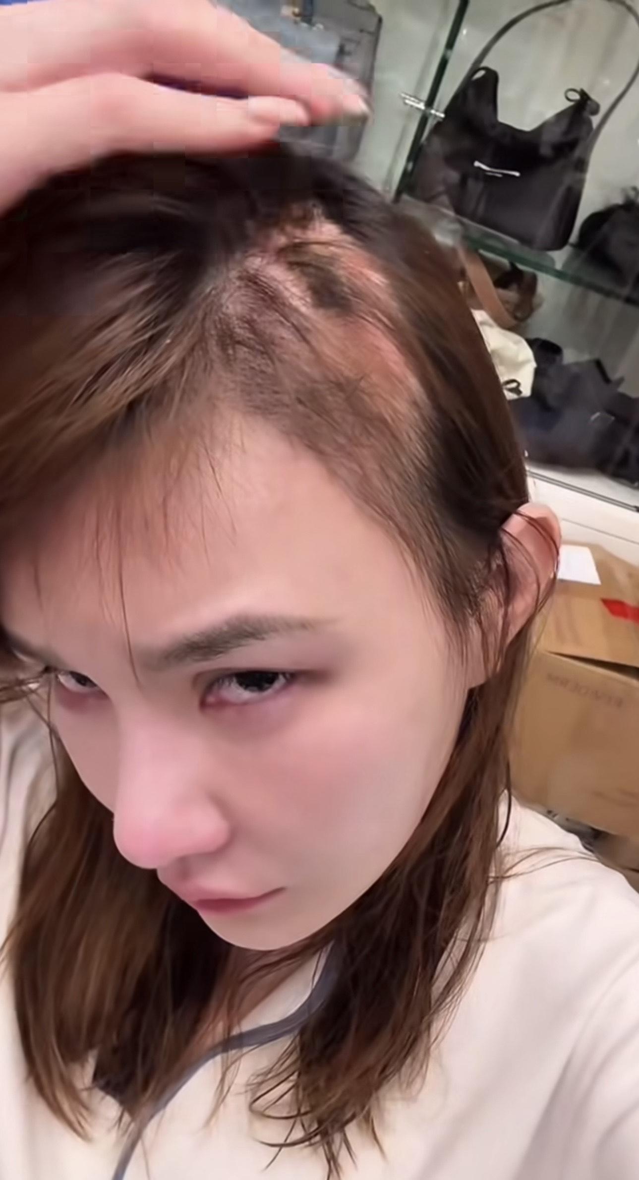 五索拍片展示嚴重甩頭髮,頭頂禿了一大撻如「鬼剃頭」般的恐怖情況。