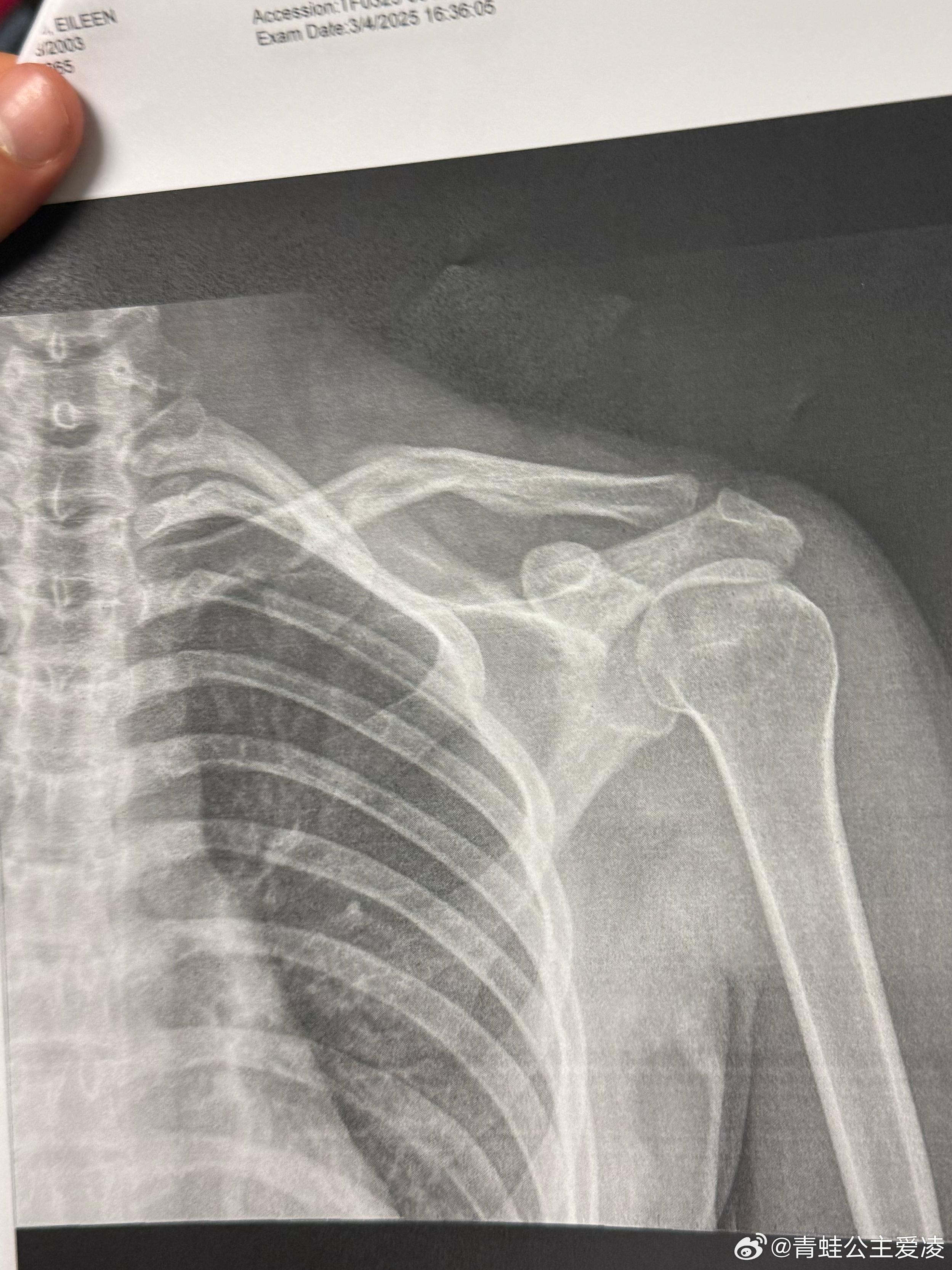 北京冬奧滑雪兩金得主谷愛凌在微博曬出骨折X光照片。(谷愛凌微博)