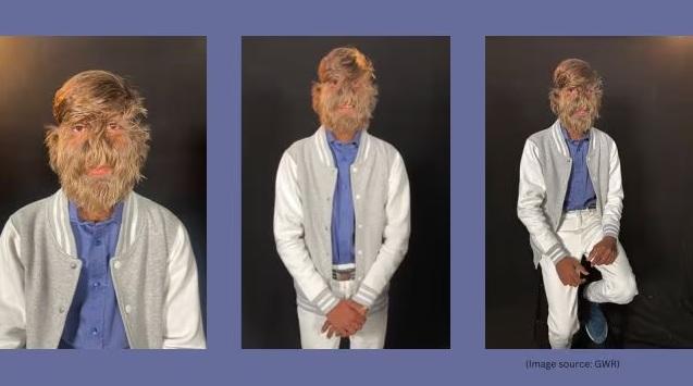 帕蒂達爾近日獲健力士認證為「臉部毛髮最濃密的男性」。(互聯網)