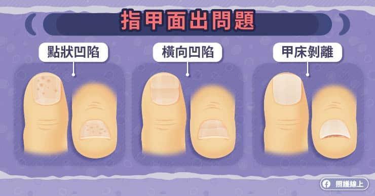 指甲顏色變化反映健康|(照護線上)