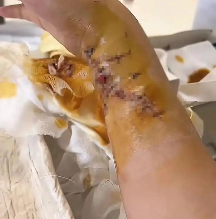 李女士手上傷口深到見骨,經歷5小時手術、縫了100多針,被鑑定為10級傷殘。(微博)