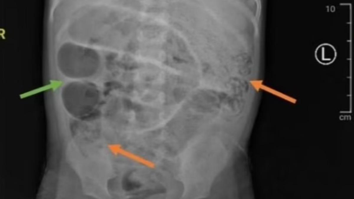 X光顯示男童胃部出現不明灰色腫塊。(X)