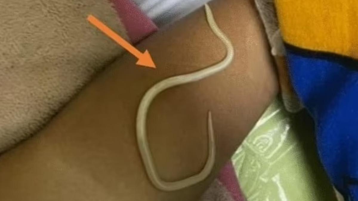 醫生隨即為男童進行手術,驚訝發現多條蛔蟲阻塞了他小腸的3個不同區域。(X)