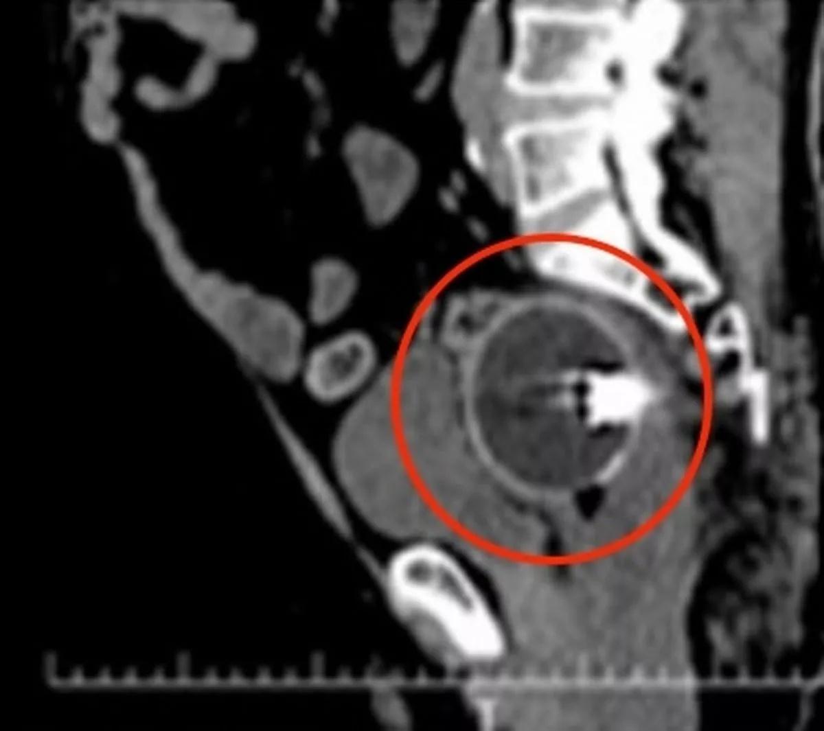 球卡在男子的直腸內,距離肛門約7厘米處。(ScienceDirect)