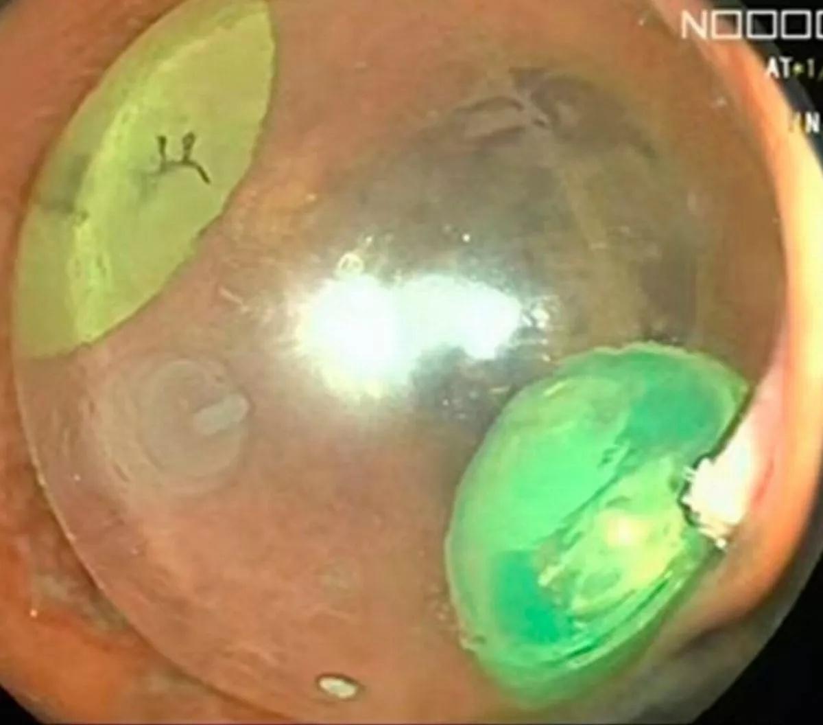 醫生決定將閃光球刺破,待裡面的液體、空氣排出,再將「漏氣」球體拉出來。(ScienceDirect)
