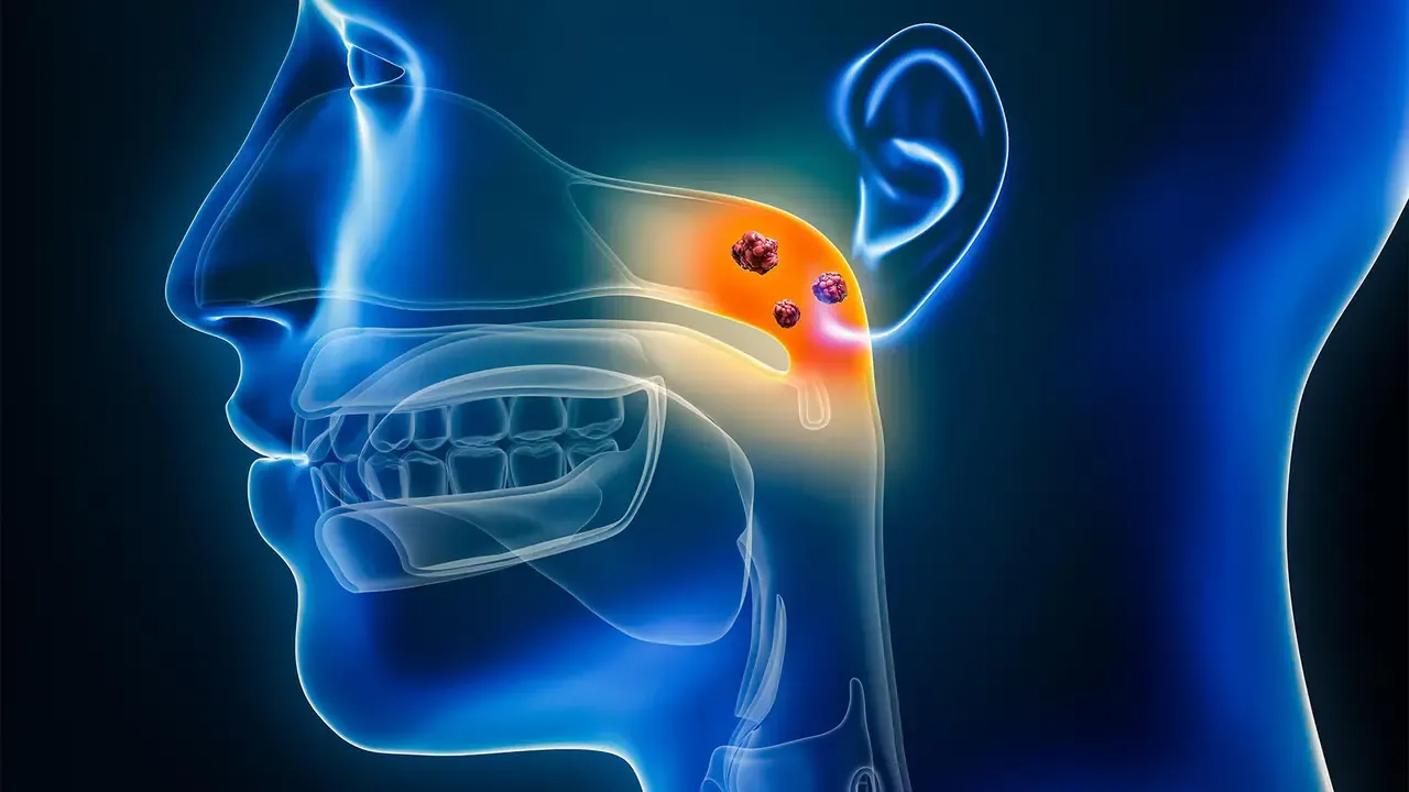 鼻咽癌高風險族群包括家族中有鼻咽癌病及鼻竇炎病史者,以及經常吸煙、飲酒,或喜食醃製食品、醬菜類、發酵品等習慣有關。