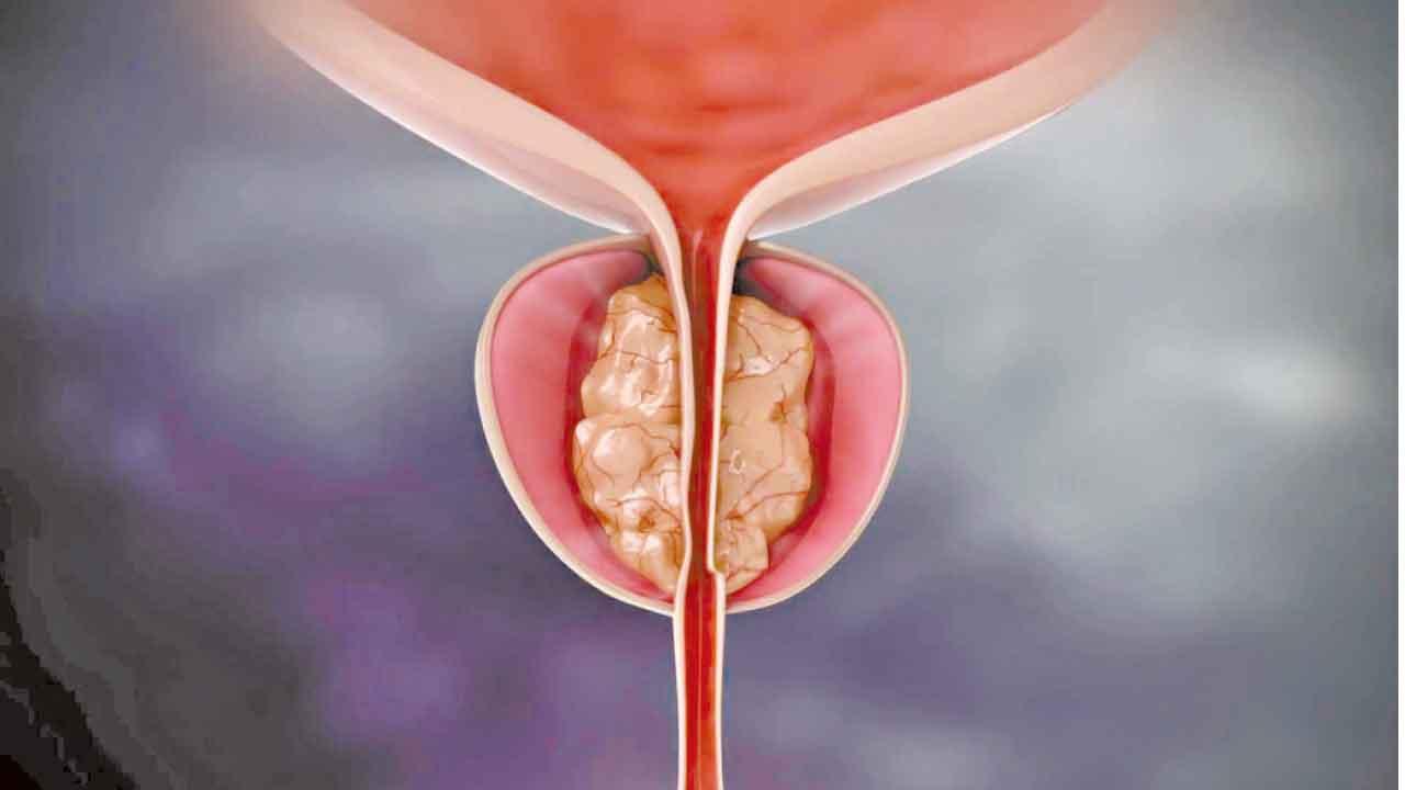 良性前列腺增生