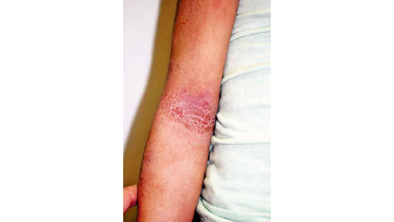 兩年前預測居然成真!嬰兒濕疹後遺症(上)