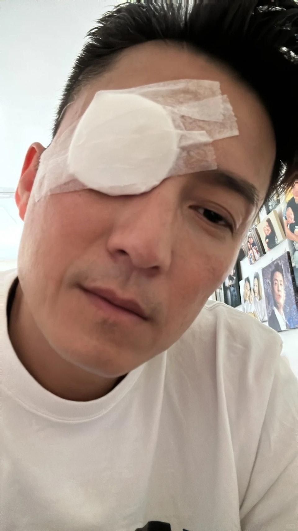 陳山聰前日(18日)在社交網分享了一張眼貼紗布的照片。