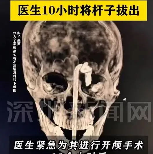 內地男酒後摔倒鐵桿插入口 直穿顱內緊急送院搶救(網圖)