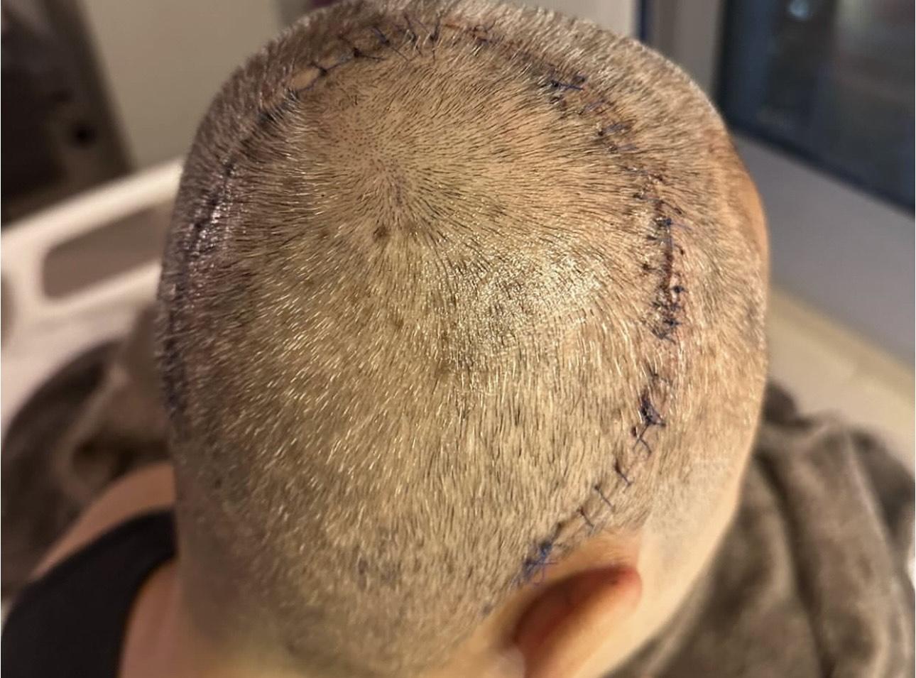 蔡一傑去年接受腦部切除腫瘤手術後,頭上留下U型大疤痕。