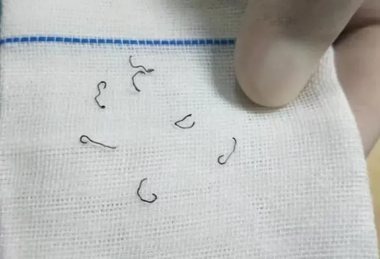 女子做痔瘡手術留「隱患」,10年8次手術取出30多枚鈦釘。(網易圖片)