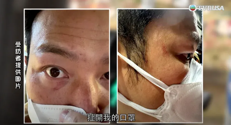 前TVB藝人趙敏通旺角遇襲眼角受傷