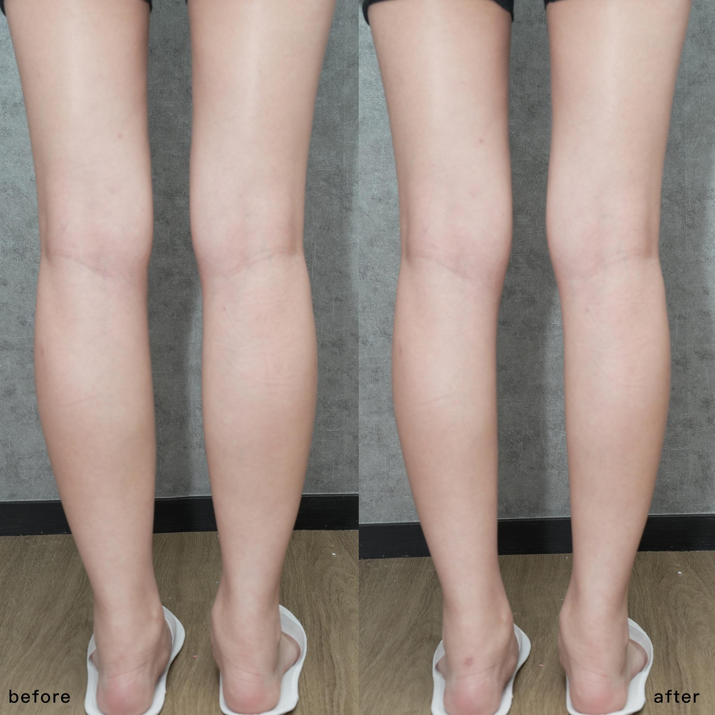 「熱磁筋膜刀」效果對比