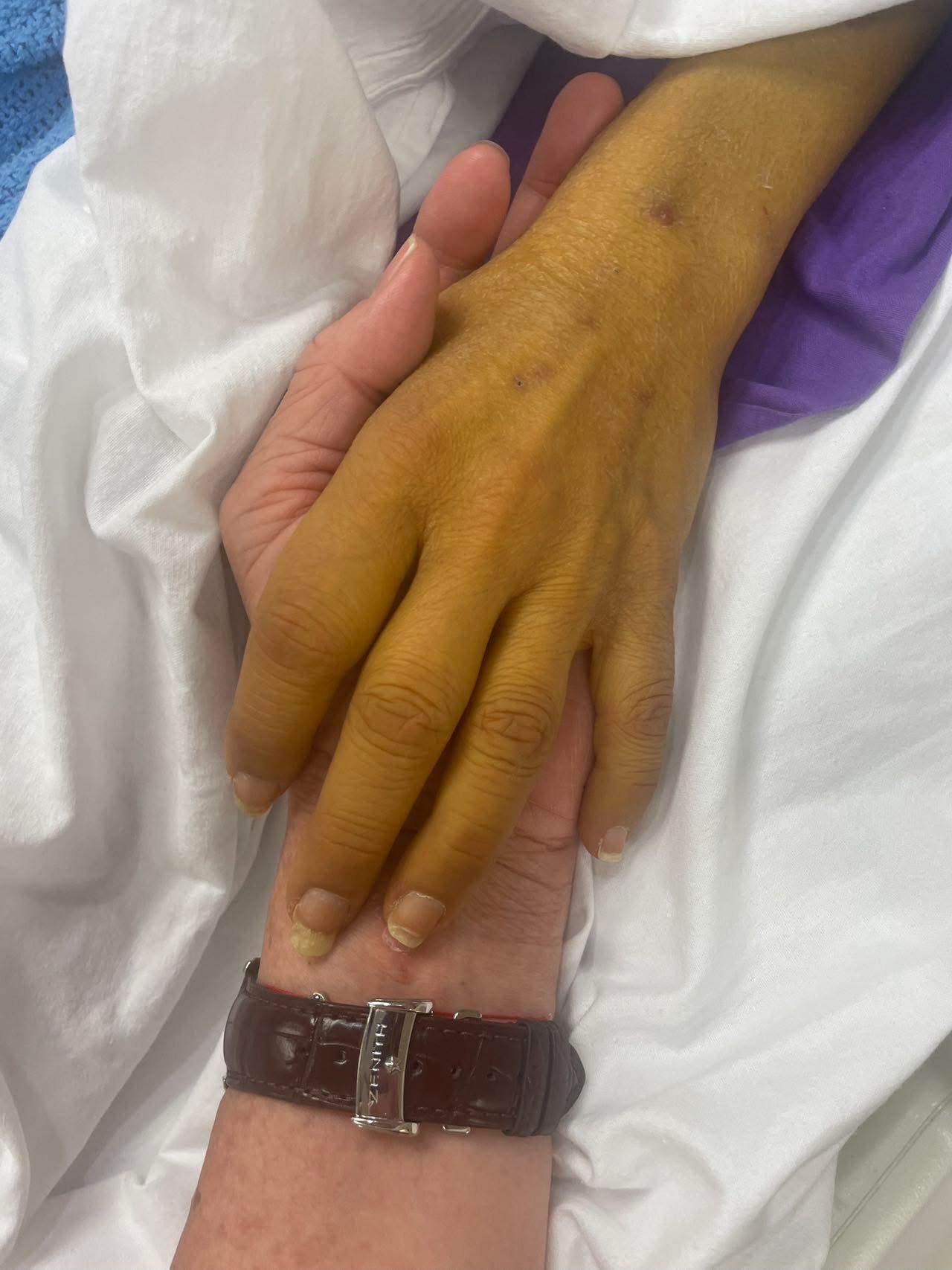 因肝病影響,Lisa 的手已呈深黃色。