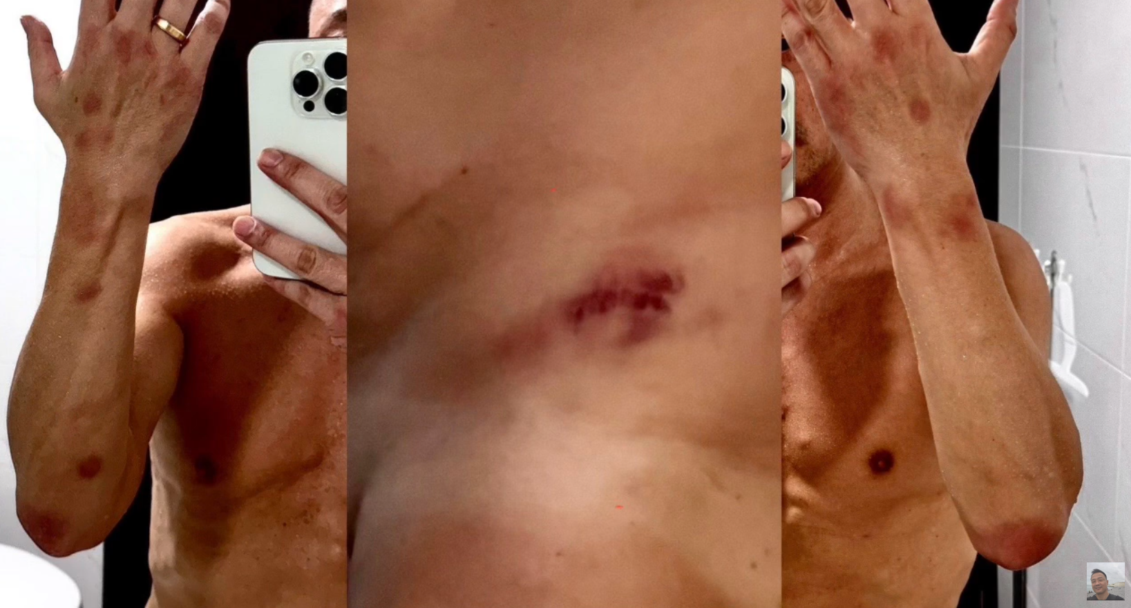 王喜在2024年12月10日發生第二次類似遭遇,並拍下當時傷勢。